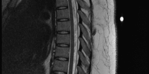 척추 MRI 사