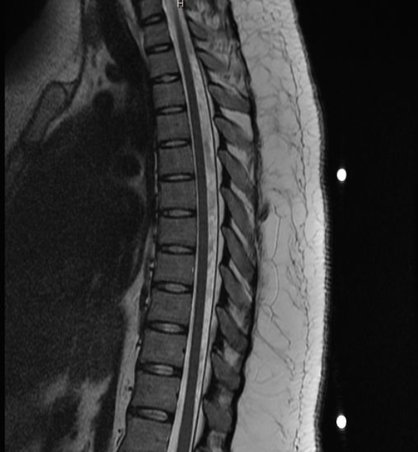 척추 MRI 사진